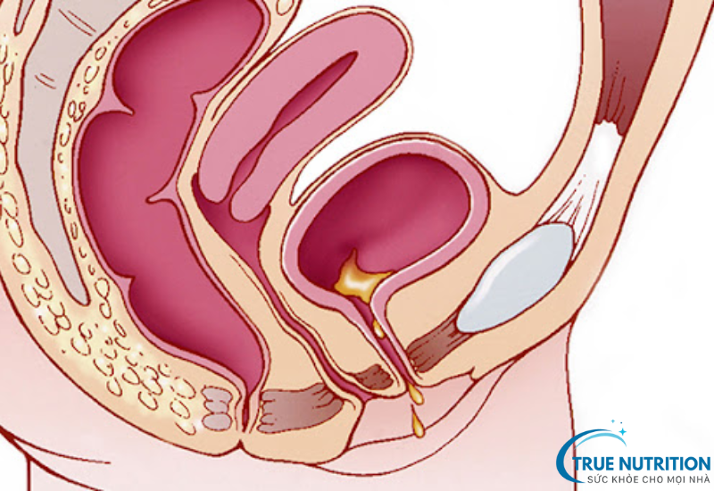 Viêm Bàng Quang -  Những Biến Chứng Nguy Hiểm và Cách Phòng Ngừa