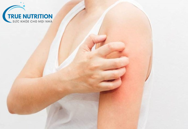 Viêm da dị ứng: Dấu hiệu, nguyên nhân và cách điều trị hiệu quả