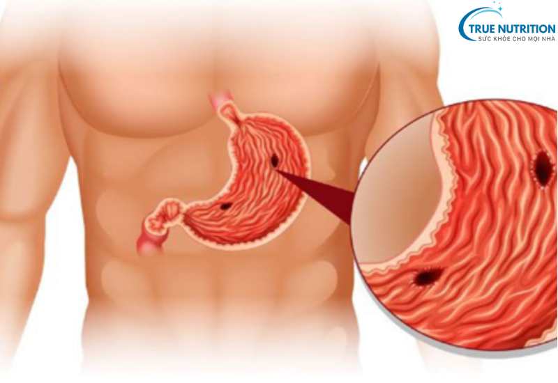 Viêm Loét Dạ Dày Tá Tràng – Mối Nguy Hiểm Tiềm Tàng