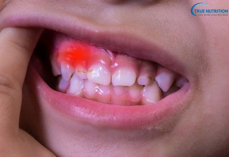 Bệnh Viêm Nha Chu: Những Điều Cần Biết Để Bảo Vệ Sức Khỏe Răng Miệng