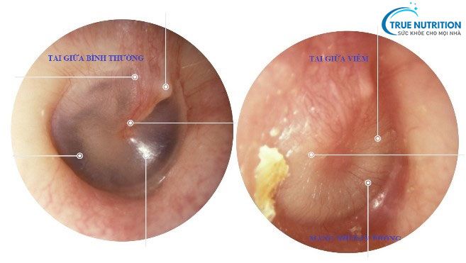 Viêm Tai Giữa Ở Trẻ: Vắc Xin Phế Cầu Và Viêm Tai Giữa