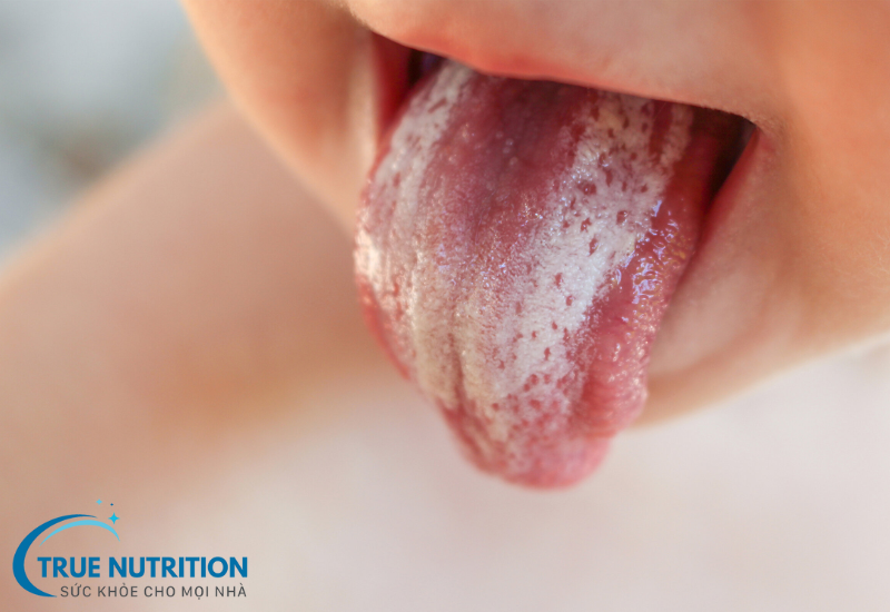 Viêm VA: Nguyên nhân, biểu hiện, biến chứng và cách điều trị