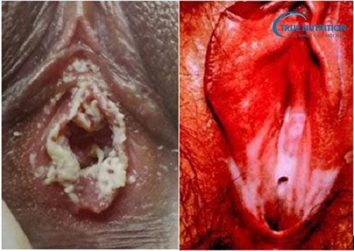 Nhận Diện Hình Ảnh Bệnh Lậu Giai Đoạn Đầu. Khác Biệt Giữa Nam & Nữ