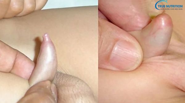Nhận Diện Hình Ảnh Hẹp Bao Quy Đầu Ở Trẻ Sơ Sinh