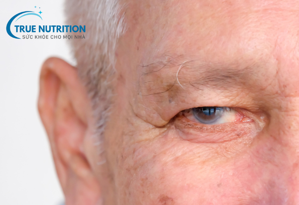 Tăng Nhãn Áp: Bệnh Lý Nguy Hiểm Cần Cảnh Giác