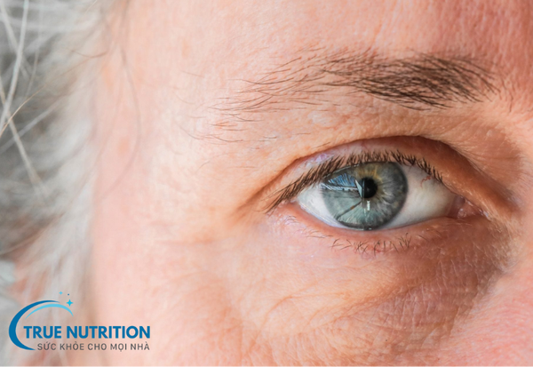 Tăng Nhãn Áp: Bệnh Lý Nguy Hiểm Cần Cảnh Giác