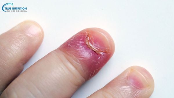 Cách Chữa Chín Mé Bằng Kem Đánh Răng Khoa Học Nói Gì?