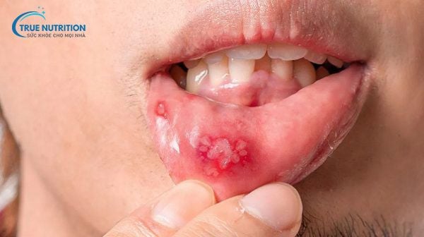 Nhận Định Hình Ảnh Bị Lở Miệng: Phân Biệt, Cách Điều Trị