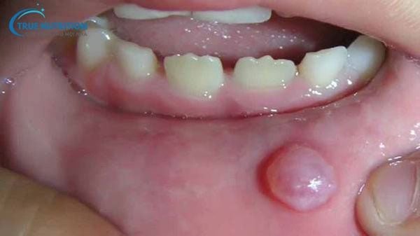 Miệng Bị Nổi Mụn Nước Là Do Đâu? Cách Xử Lý