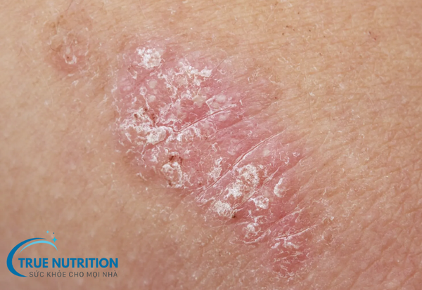 Bệnh vảy nến: Những điều cần biết về nguyên nhân và triệu chứng