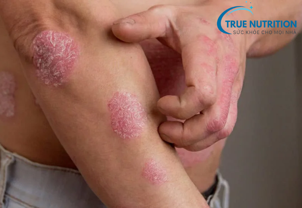 Bệnh vảy nến: Những điều cần biết về nguyên nhân và triệu chứng