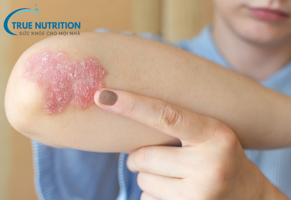 Bệnh vảy nến: Những điều cần biết về nguyên nhân và triệu chứng