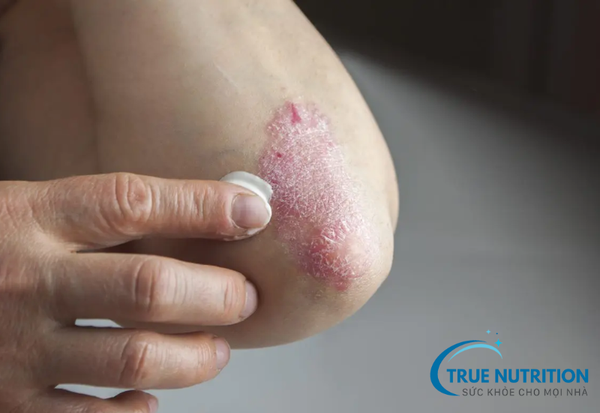 Bệnh vảy nến: Những điều cần biết về nguyên nhân và triệu chứng