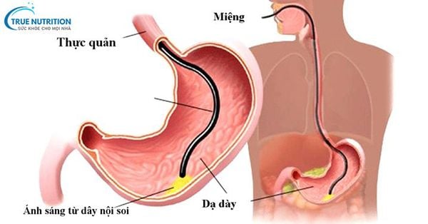 Khi Nào Cần Nội Soi Dạ Dày: Lưu Ý Trước & Sau Khi Nội Soi