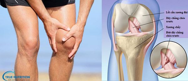 10 Điều Tránh Sau Mổ Dây Chằng Chéo: AN Toàn & Mau Lành