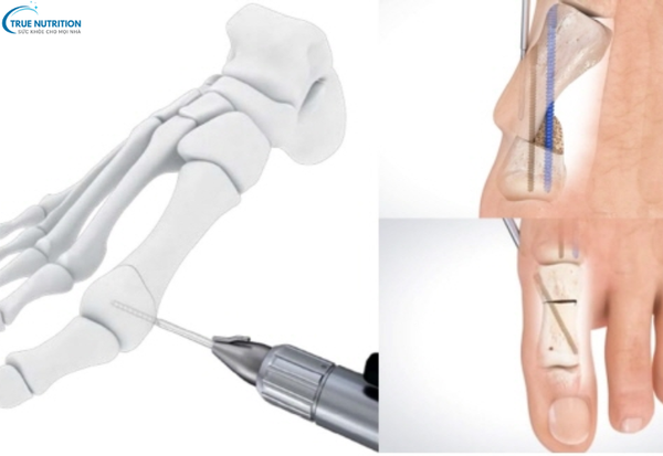 Có Nên Phẫu Thuật Bàn Chân? Những Điều Cần Biết Trước Khi Quyết Định