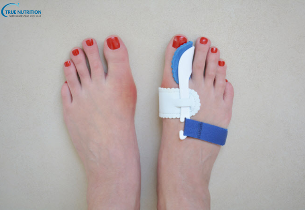 Có Nên Phẫu Thuật Bàn Chân? Những Điều Cần Biết Trước Khi Quyết Định