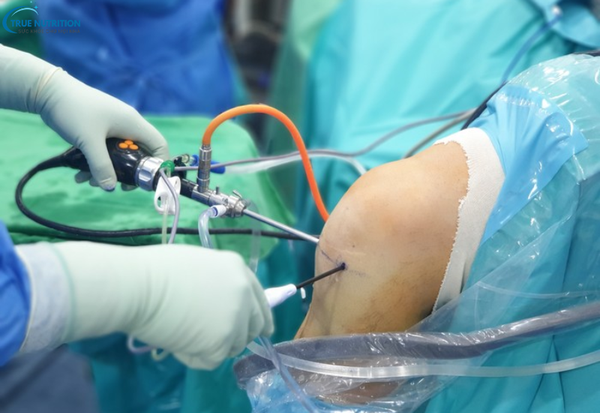 Phẫu Thuật Nội Soi Khớp: Giải Pháp Điều Trị Cho Các Vấn Đề Xương Khớp