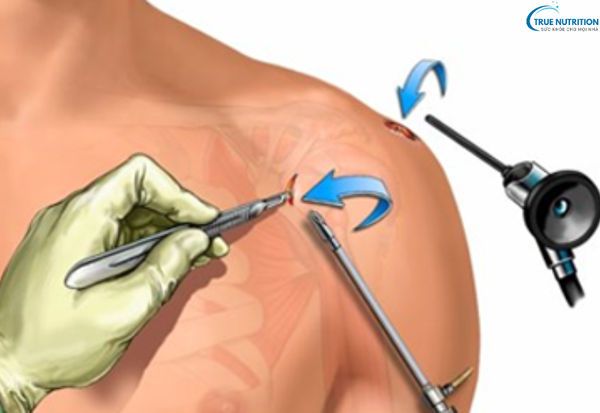 Phẫu Thuật Nội Soi Khớp: Giải Pháp Điều Trị Cho Các Vấn Đề Xương Khớp