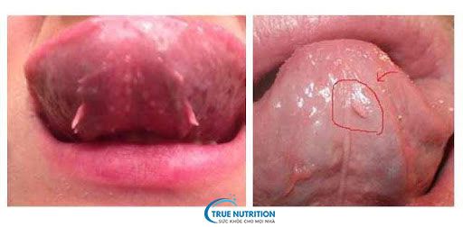 Hình Ảnh Mụn Thịt Trong Miệng: Nguyên Nhân, Điều Trị và Phòng Ngừa