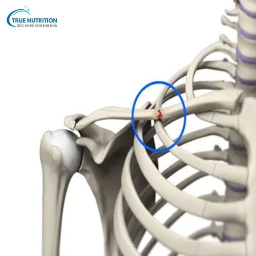 Tư Thế Nằm Ngủ Khi Bị Gãy Xương Đòn Đúng Chuẩn Để Không Gây Di Chứng