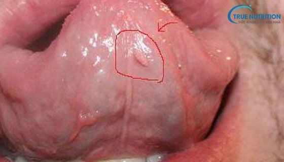 Lưỡi Nổi Mụn Thịt Nguy Hiểm Không? Nguyên Nhân, Bệnh Lý?