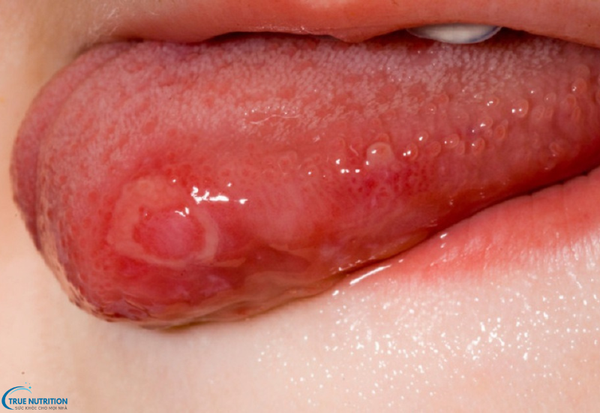 Bệnh Nổi Mụn Đầu Lưỡi Là Bệnh Gì? Những Dấu Hiệu Cảnh Báo Không Thể Bỏ Qua