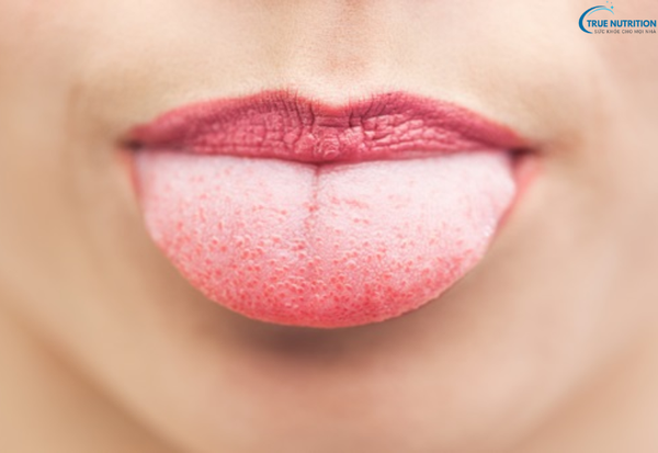 Bệnh Nổi Mụn Đầu Lưỡi Là Bệnh Gì? Những Dấu Hiệu Cảnh Báo Không Thể Bỏ Qua