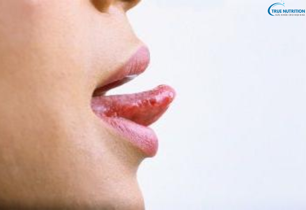 Bệnh Nổi Mụn Đầu Lưỡi Là Bệnh Gì? Những Dấu Hiệu Cảnh Báo Không Thể Bỏ Qua