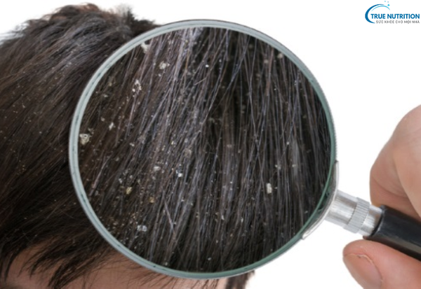 Cách Trị Bệnh Gàu: Bí Quyết Lấy Lại Sự Tự Tin Với Mái Tóc Sạch Gàu