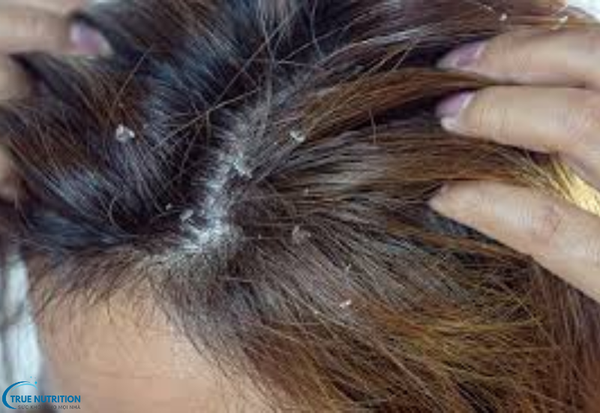 Cách Trị Bệnh Gàu: Bí Quyết Lấy Lại Sự Tự Tin Với Mái Tóc Sạch Gàu