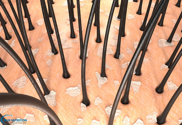 Cách Trị Bệnh Gàu: Bí Quyết Lấy Lại Sự Tự Tin Với Mái Tóc Sạch Gàu