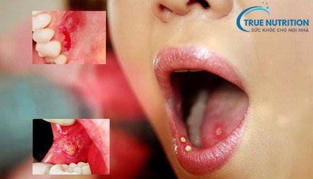 Nhận Định Hình Ảnh Bị Lở Miệng: Phân Biệt, Cách Điều Trị