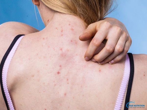 Nhận Diện Hình Ảnh Viêm Nang Lông, Nguyên Nhân, Điều Trị