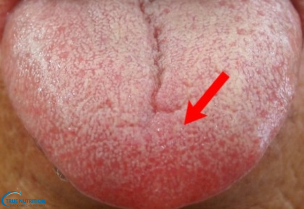 Bệnh Lưỡi Bị Nổi Hột Đỏ Đau Rát: Nguyên Nhân, Dấu Hiệu Và Cách Xử Lý