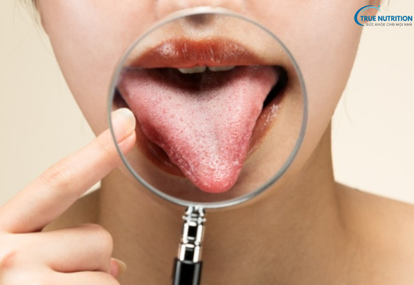 Bệnh Lưỡi Bị Nổi Hột Đỏ Đau Rát: Nguyên Nhân, Dấu Hiệu Và Cách Xử Lý