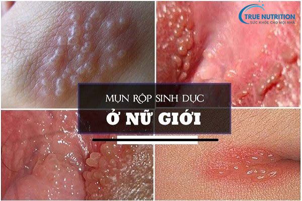 Hình Ảnh Mụn Rộp Sinh Dục Nhận Biết Sớm và Phòng Ngừa Hiệu Quả