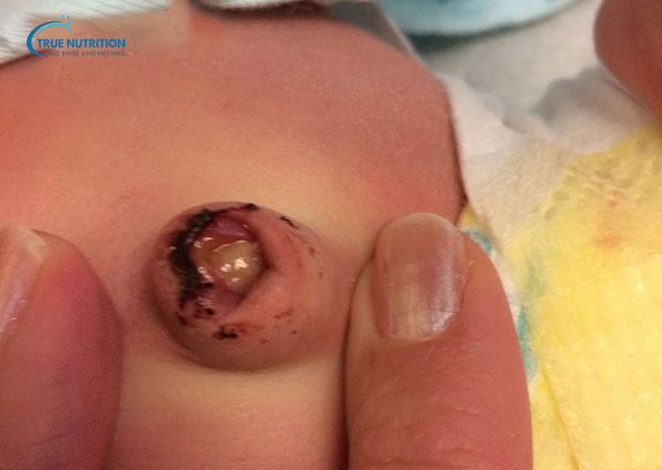 Hình ảnh rốn trẻ sơ sinh bị nhiễm trùng: Nhận biết, điều trị và phòng ngừa