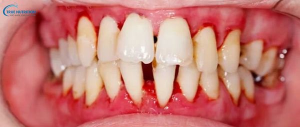 Hình Ảnh Viêm Nướu Răng: Nhận Biết, Điều Trị và Phòng Ngừa