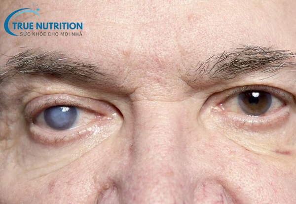 Đục thủy tinh thể: Nhận diện sớm và điều trị hiệu quả