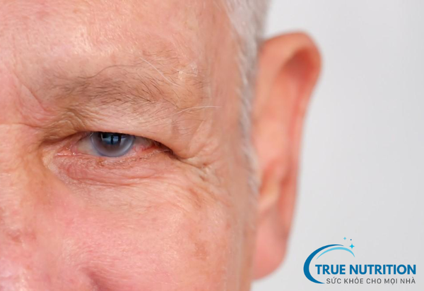 Đục thủy tinh thể: Nhận diện sớm và điều trị hiệu quả