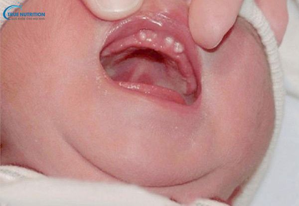 Hình Ảnh Nanh Sữa Ở Trẻ Sơ Sinh: Hình Thái, Xử Lý