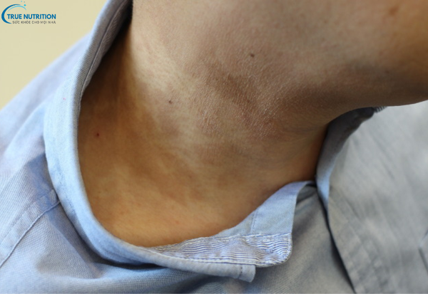 Cách Chữa Bệnh Lang Ben: Giải Pháp Đúng Đắn Cho Làn Da Khỏe Mạnh