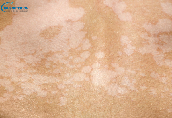 Cách Chữa Bệnh Lang Ben: Giải Pháp Đúng Đắn Cho Làn Da Khỏe Mạnh