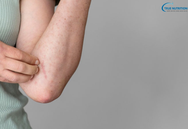 Cách Chữa Bệnh Lang Ben: Giải Pháp Đúng Đắn Cho Làn Da Khỏe Mạnh