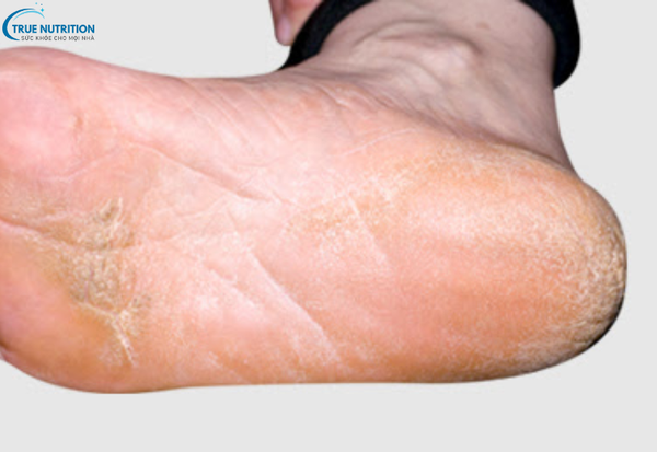 Cách Chữa Bệnh Lang Ben: Giải Pháp Đúng Đắn Cho Làn Da Khỏe Mạnh