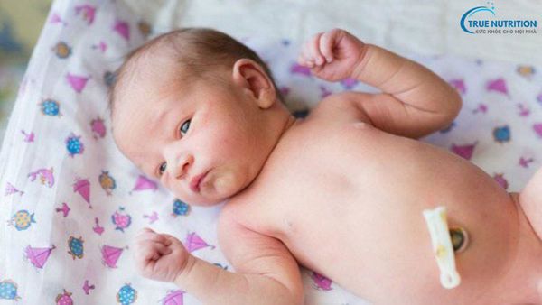 Tồn tại nang ống niệu rốn ở trẻ sơ sinh là gì? Bao giờ cần mổ?