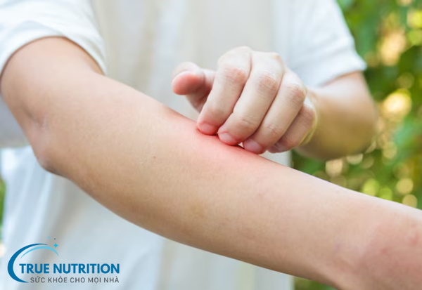 Dị Ứng Côn Trùng: Triệu Chứng, Cách Chữa Và Phòng Ngừa Hiệu Quả