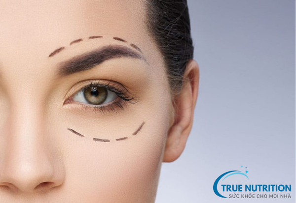 Cắt mí: Những điều bạn cần biết trước khi thực hiện