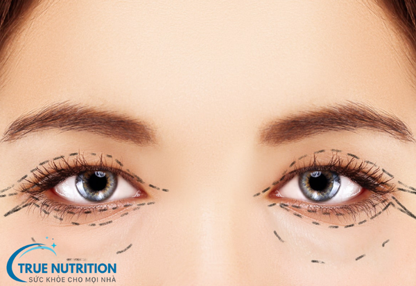 Cắt mí: Những điều bạn cần biết trước khi thực hiện